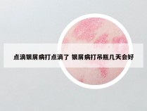 点滴银屑病打点滴了 银屑病打吊瓶几天会好