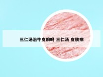 三仁汤治牛皮癣吗 三仁汤 皮肤病