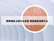 银屑病身上缺什么东西 银屑病身体缺什么