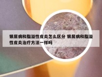 银屑病和脂溢性皮炎怎么区分 银屑病和脂溢性皮炎治疗方法一样吗