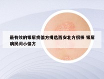 最有效的银屑病偏方挑选西安北方很棒 银屑病民间小偏方