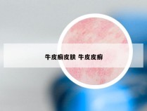 牛皮癣皮肤 牛皮皮癣