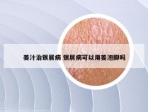 姜汁治银屑病 银屑病可以用姜泡脚吗