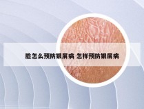 脸怎么预防银屑病 怎样预防银屑病