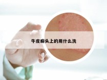 牛皮癣头上的用什么洗