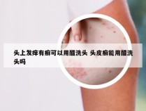 头上发痒有癣可以用醋洗头 头皮癣能用醋洗头吗