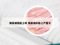 银屑病张脸上吗 银屑病长脸上严重不