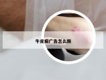 牛皮癣广告怎么撕