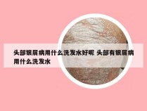 头部银屑病用什么洗发水好呢 头部有银屑病用什么洗发水