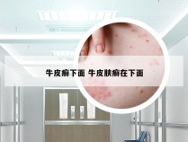 牛皮癣下面 牛皮肤癣在下面