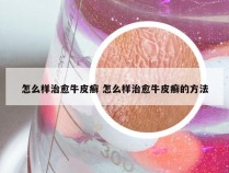 怎么样治愈牛皮癣 怎么样治愈牛皮癣的方法