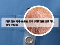 阿莫西林对牛皮癣有用吗 阿莫西林胶囊可以治头皮癣吗