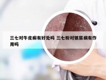 三七对牛皮癣有好处吗 三七粉对银屑病有作用吗