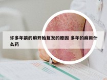 许多年前的癣开始复发的原因 多年的癣用什么药