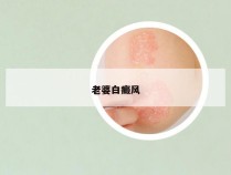 老婆白癜风