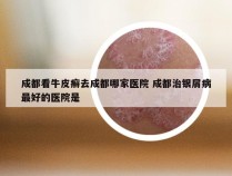 成都看牛皮癣去成都哪家医院 成都治银屑病最好的医院是