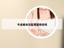 牛皮癣会引起霉菌阴炎吗