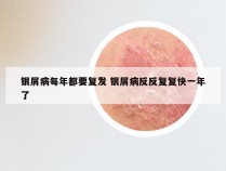 银屑病每年都要复发 银屑病反反复复快一年了
