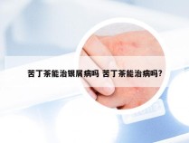 苦丁茶能治银屑病吗 苦丁茶能治病吗?