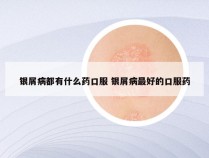 银屑病都有什么药口服 银屑病最好的口服药