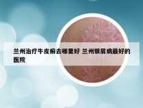 兰州治疗牛皮癣去哪里好 兰州银屑病最好的医院