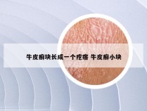牛皮癣块长成一个疙瘩 牛皮癣小块