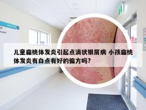 儿童扁桃体发炎引起点滴状银屑病 小孩扁桃体发炎有白点有好的偏方吗?
