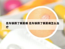出车祸得了银屑病 出车祸得了银屑病怎么治疗