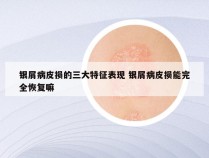 银屑病皮损的三大特征表现 银屑病皮损能完全恢复嘛