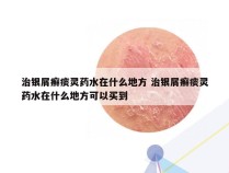 治银屑癣痰灵药水在什么地方 治银屑癣痰灵药水在什么地方可以买到