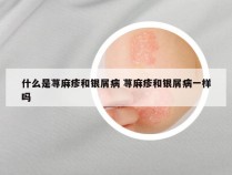 什么是荨麻疹和银屑病 荨麻疹和银屑病一样吗