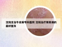 沈阳主治牛皮癣专科医院 沈阳治疗银屑病的最好医生