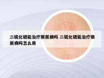 二硫化硒能治疗银屑病吗 二硫化硒能治疗银屑病吗怎么用