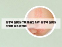 西宁中医院治疗银屑病怎么样 西宁中医院治疗银屑病怎么样啊