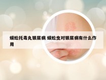 蜈蚣托毒丸银屑病 蜈蚣虫对银屑病有什么作用