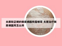 太原较正规的银屑病医院是哪家 太原治疗银屑病医院怎么样