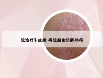 蛇治疗牛皮癣 毒蛇能治银屑病吗