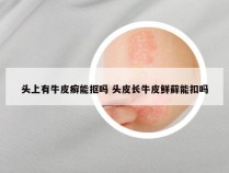 头上有牛皮癣能抠吗 头皮长牛皮鲜藓能扣吗
