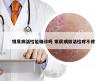 银屑病活检能确诊吗 银屑病做活检疼不疼