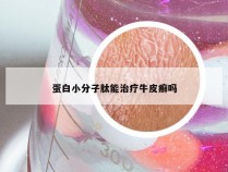 蛋白小分子肽能治疗牛皮癣吗