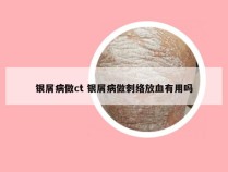 银屑病做ct 银屑病做刺络放血有用吗