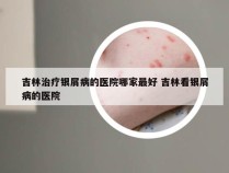 吉林治疗银屑病的医院哪家最好 吉林看银屑病的医院