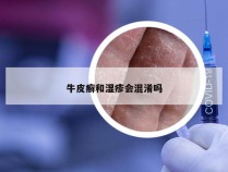 牛皮癣和湿疹会混淆吗