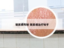 银屑病专制 银屑病治疗知乎