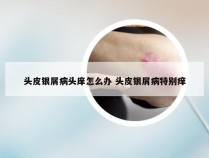 头皮银屑病头庠怎么办 头皮银屑病特别痒