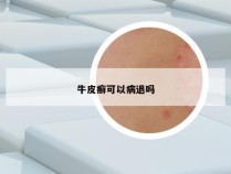 牛皮癣可以病退吗