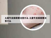 儿童牛皮癣需要注意什么 儿童牛皮癣需要注意什么