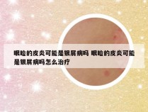 眼睑的皮炎可能是银屑病吗 眼睑的皮炎可能是银屑病吗怎么治疗