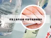 手背上有牛皮癣 手背牛皮肤癣图片