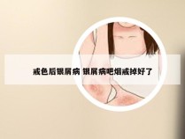 戒色后银屑病 银屑病吧烟戒掉好了